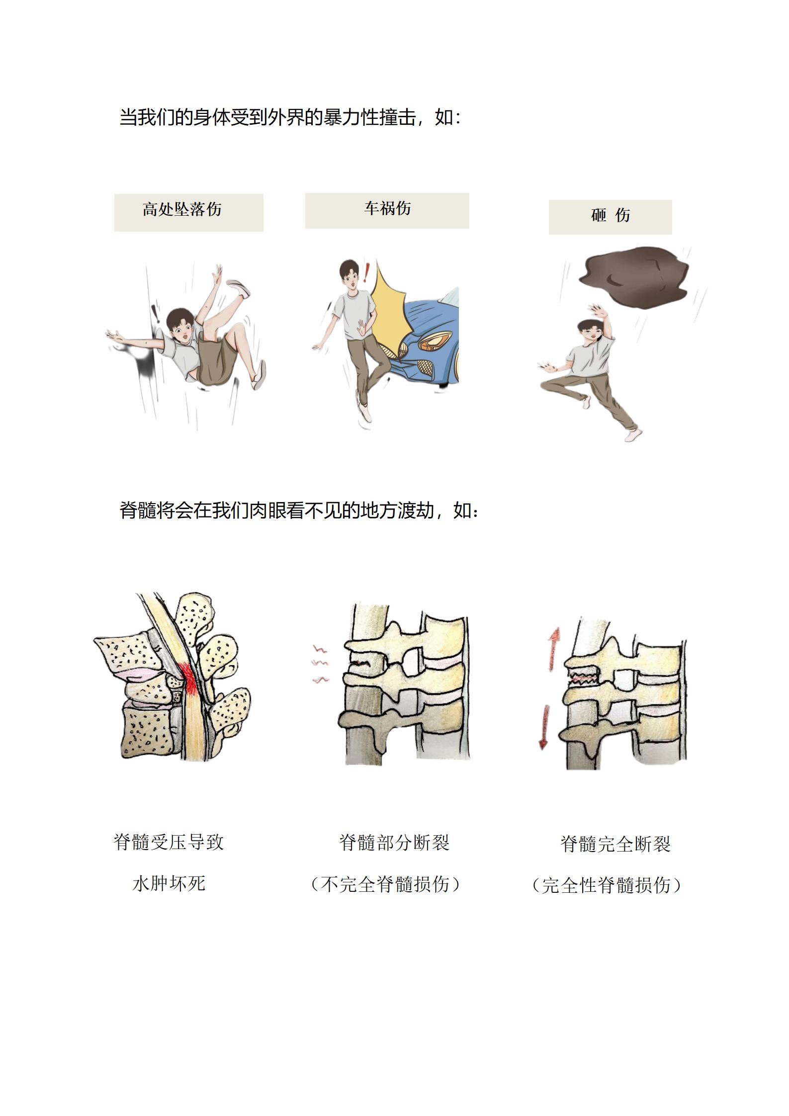脊髓损伤,切勿“髓”心所欲