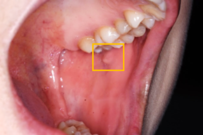 舌头叶状乳头炎症状图片
